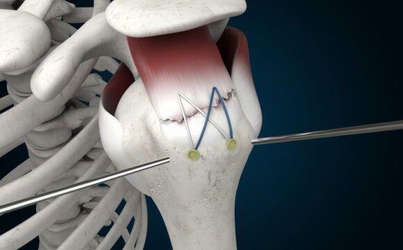 Rotator Kılıf (Cuff) Yaralanmaları